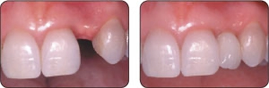 Columbus OH Dental Implants