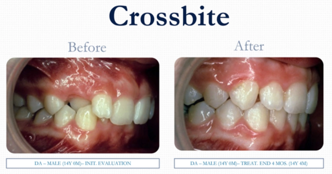 crossbite-img-01