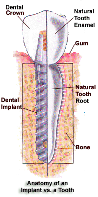 Columbus Dentist Dental Implant