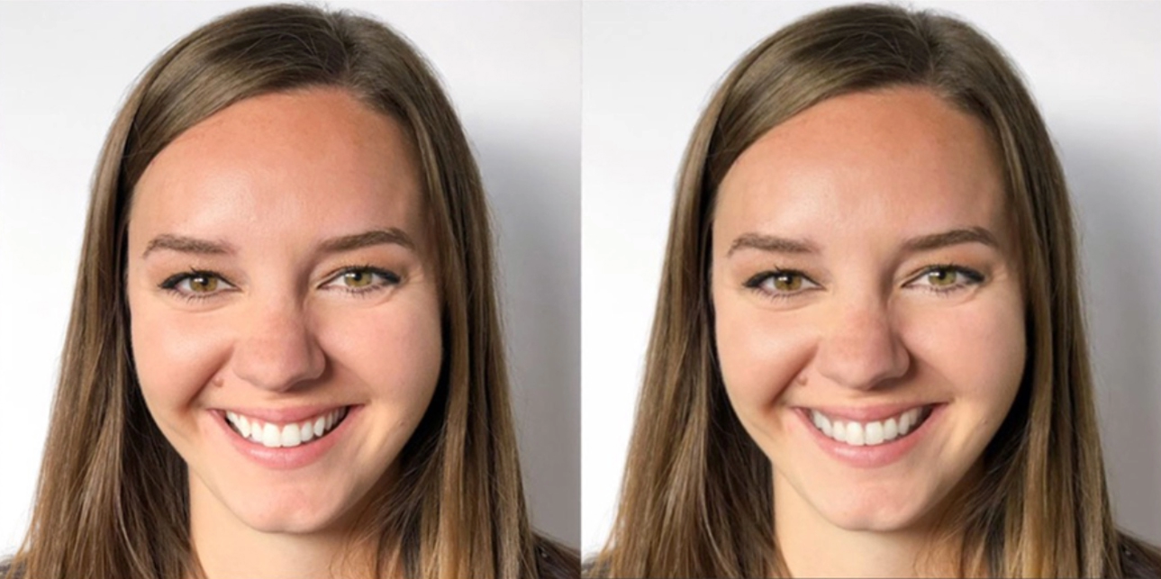 Invisalign smile preview