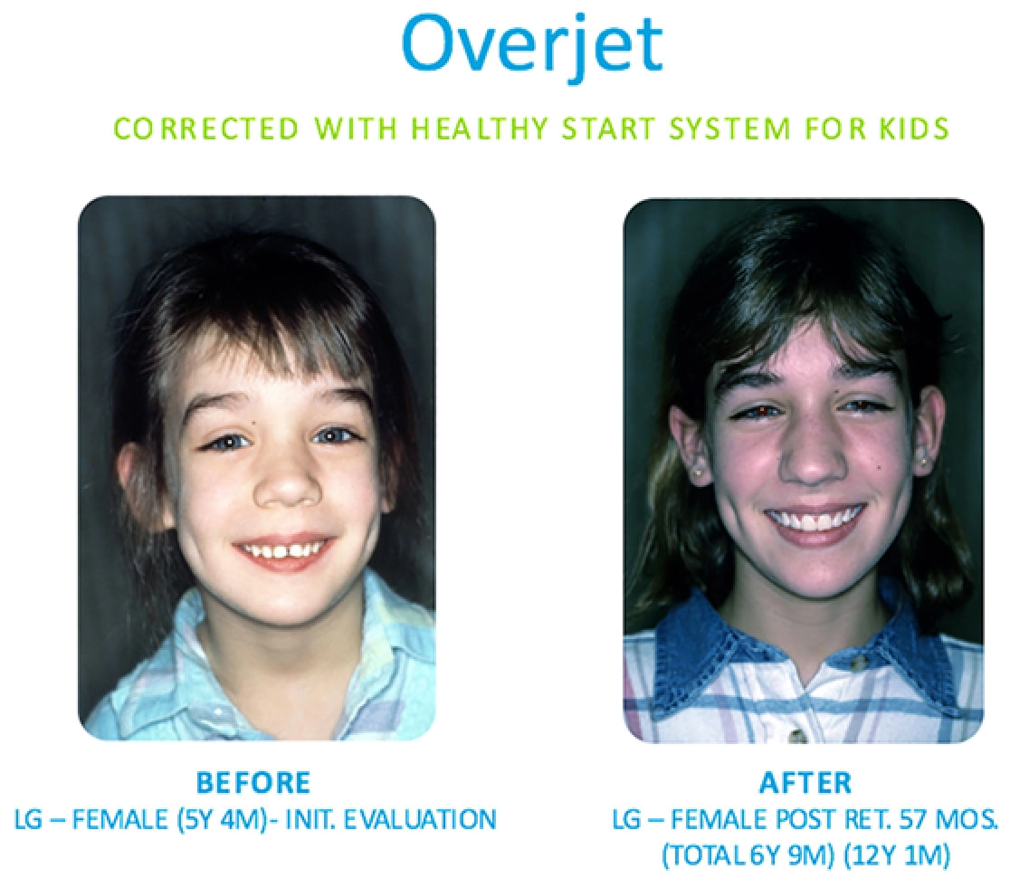 overjet-img-01