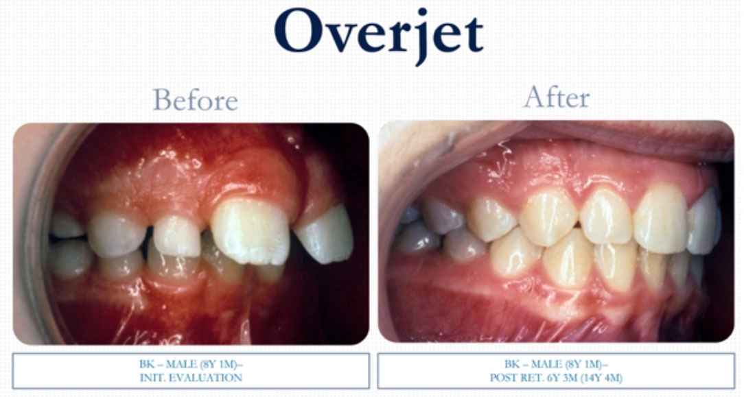 overjet-img-02