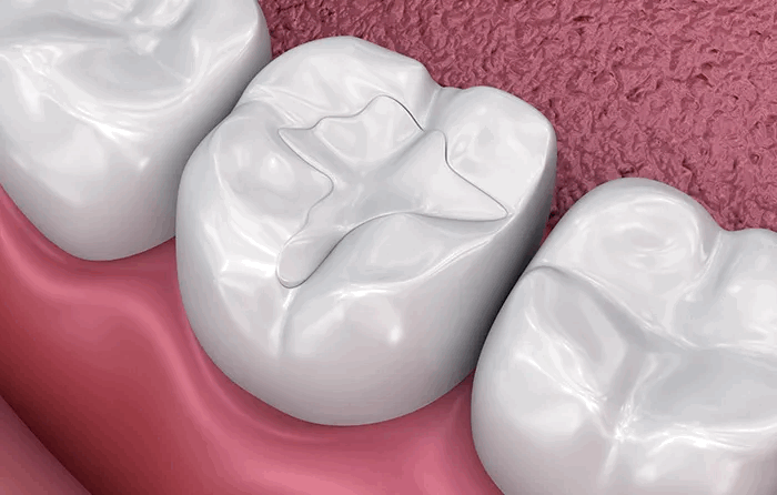 tooth-colored-img