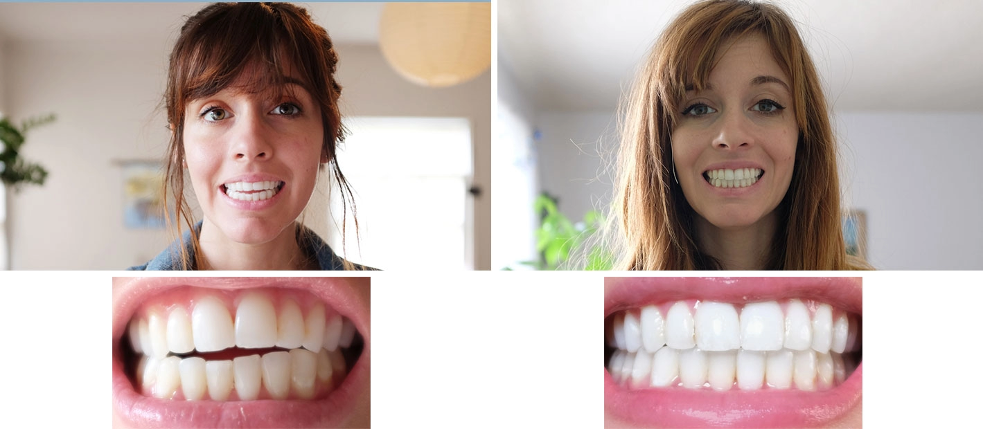 Smile gallery case 1