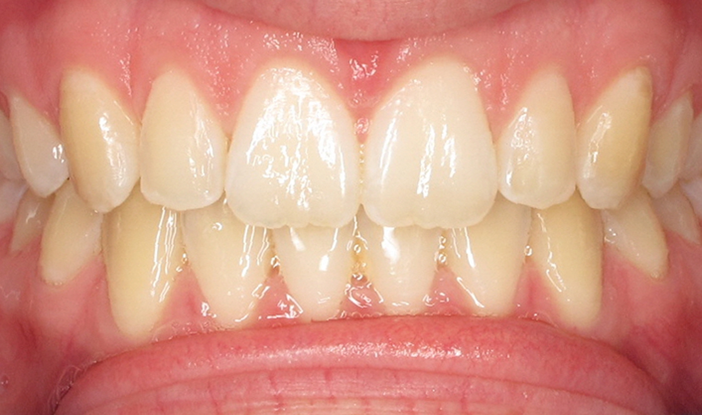 Smileview-After-Case03