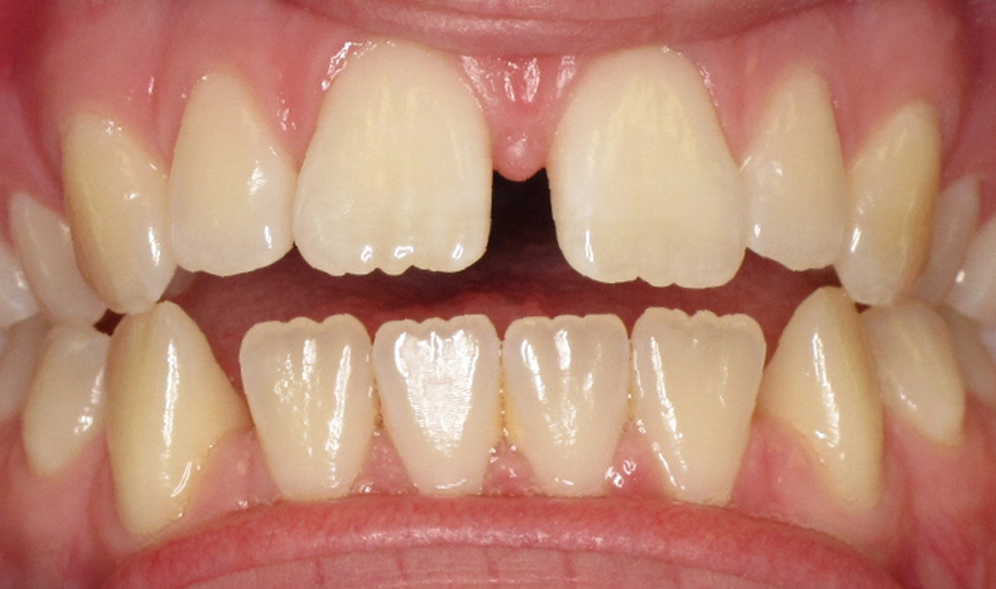 Smileview-Before-Case03