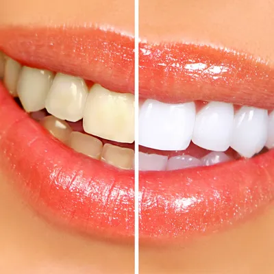 teeth-whitening-callout